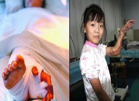 Cina: Le innestano la mano al polpaccio e dopo tre mesi la riattaccano al posto giusto