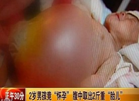 Cina shock: Bimbo di due anni “partorisce” il gemello parassita