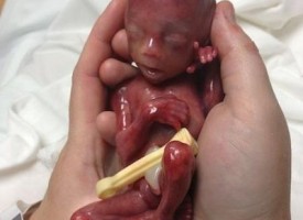 Bimbo prematuro nasce a sole 19 settimane: ecco le foto della storia più commovente di sempre