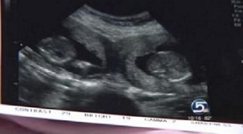 donna con due uteri
