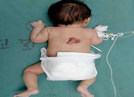 Bambino cinese nasce con il pene sulla schiena