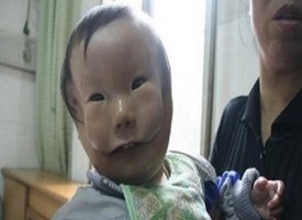 Kang Kang il bambino cinese nato con la maschera al volto