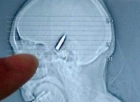 In Germania un uomo vive per 5 anni con una pallottola in testa